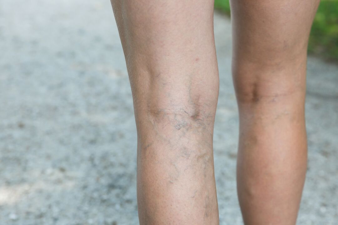 With varicose veins, an exercise program should be discussed with your doctor. 
